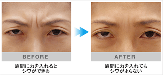 表情ジワにボツリヌストキシン注射が効果的