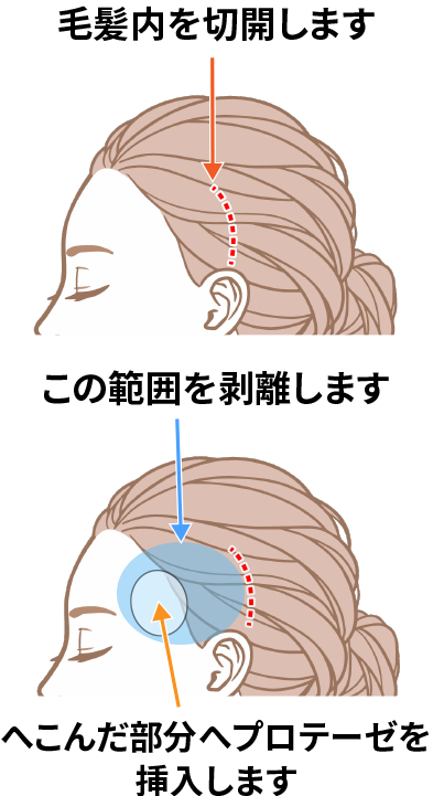 A(I字型)、B(L字型)