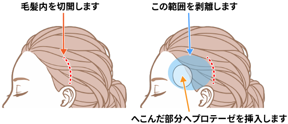 A(I字型)、B(L字型)