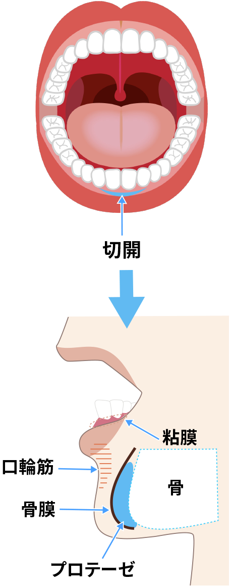 ①余分な脂肪を除去。 ②軟骨の一部を切除。 ③2つの軟骨を縛って寄せておく。