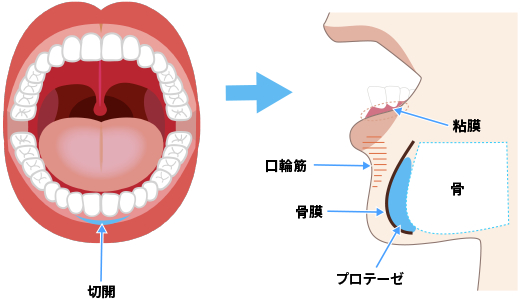 ①余分な脂肪を除去。 ②軟骨の一部を切除。 ③2つの軟骨を縛って寄せておく。
