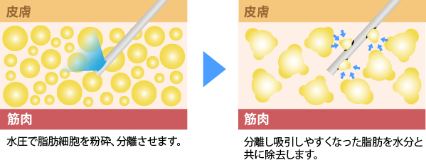 水圧で脂肪細胞を粉砕、分離させます。 → 分離し吸引しやすくなった脂肪を水分と共に除去します。