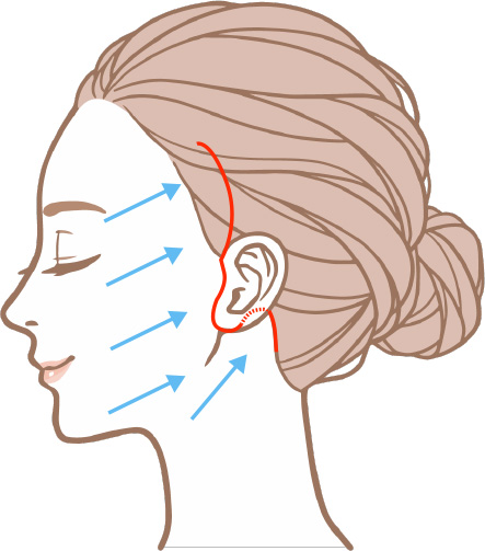 フルフェイスリフト