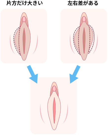 A(I字型)、B(L字型)