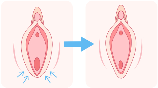 ①余分な脂肪を除去。 ②軟骨の一部を切除。 ③2つの軟骨を縛って寄せておく。