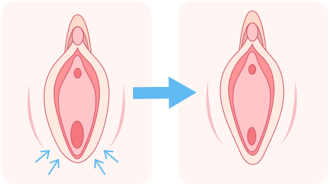 ①余分な脂肪を除去。 ②軟骨の一部を切除。 ③2つの軟骨を縛って寄せておく。
