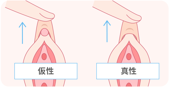①余分な脂肪を除去。 ②軟骨の一部を切除。 ③2つの軟骨を縛って寄せておく。