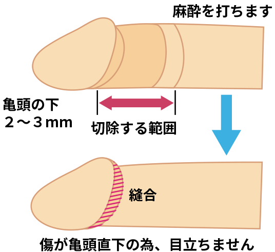包茎手術の方法