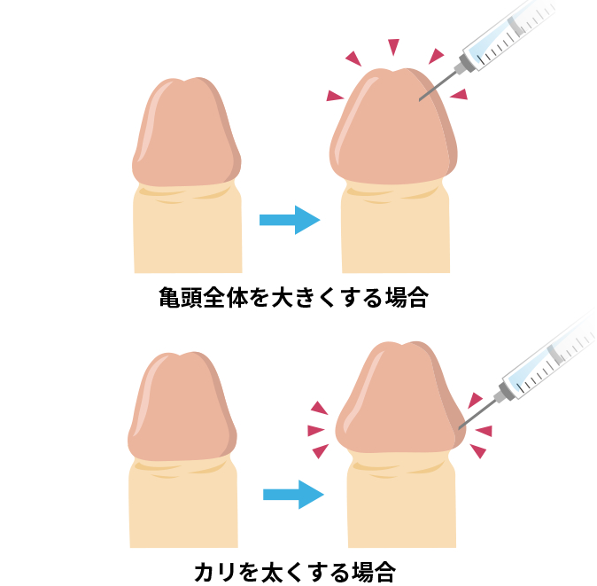 亀頭増大術の手術方法