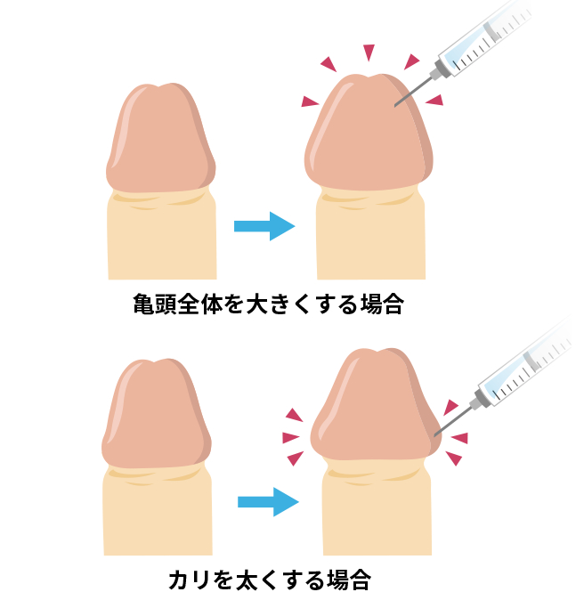 亀頭増大術の手術方法