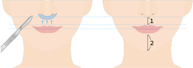 A(I字型)、B(L字型)