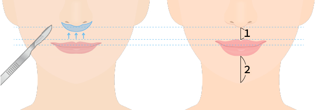 A(I字型)、B(L字型)