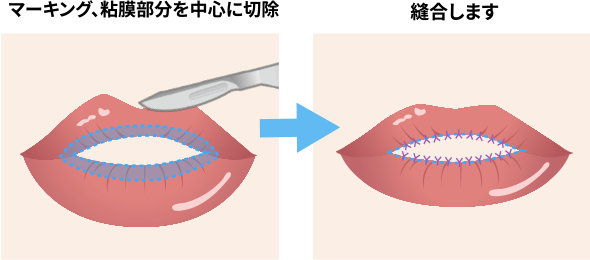 ①余分な脂肪を除去。 ②軟骨の一部を切除。 ③2つの軟骨を縛って寄せておく。