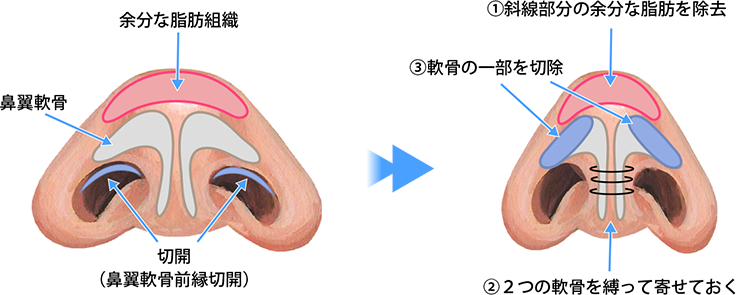 ①余分な脂肪を除去。 ②軟骨の一部を切除。 ③2つの軟骨を縛って寄せておく。