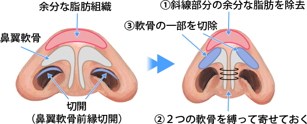 ①余分な脂肪を除去。 ②軟骨の一部を切除。 ③2つの軟骨を縛って寄せておく。