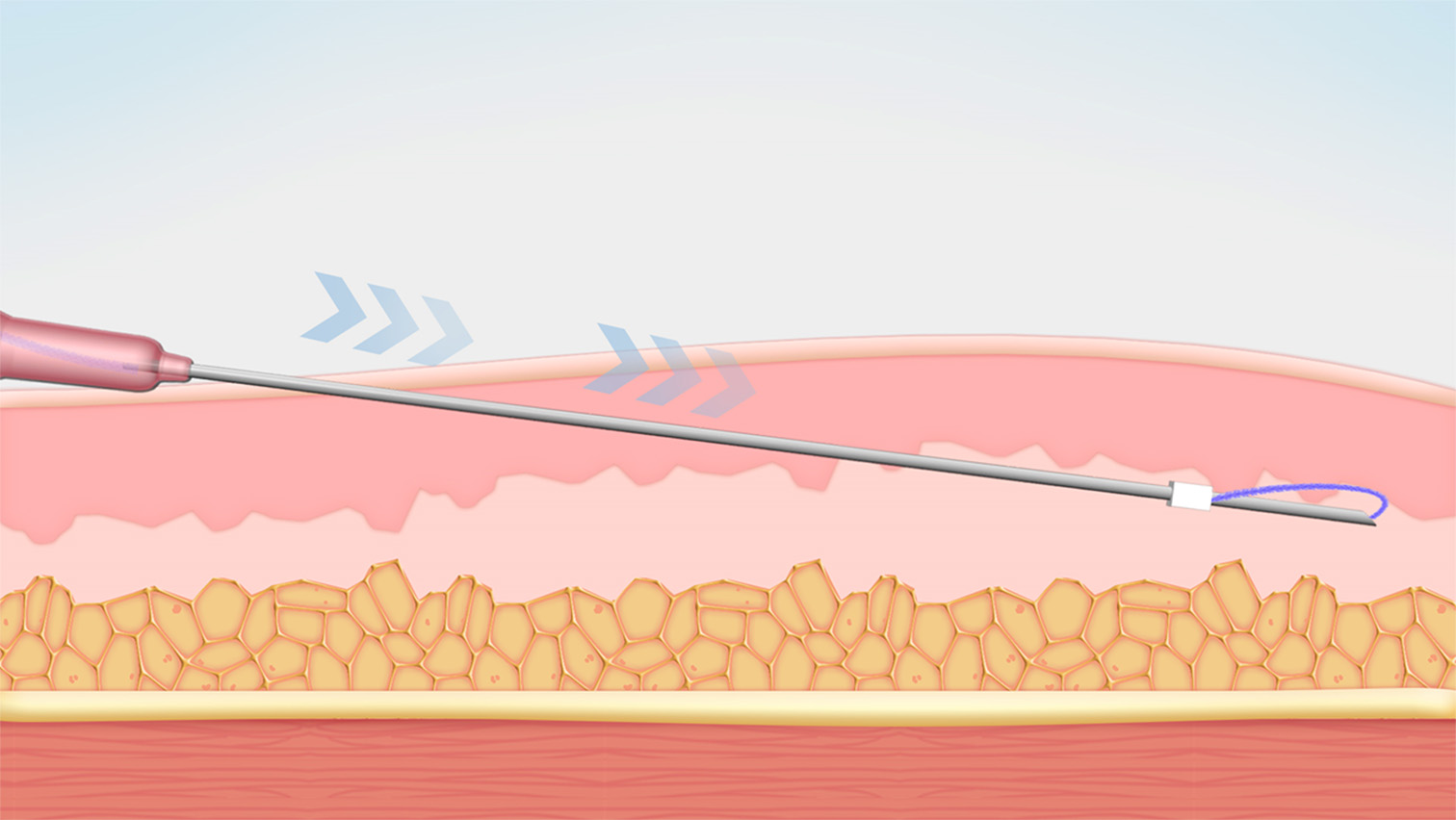 ①皮下層に中空の細い針を通し、テスリフトを挿入していきます。