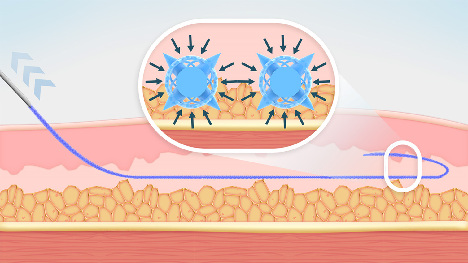 ②3Dメッシュ部分に皮下組織が絡みこみやすい場所へ配置します。糸の先端を折り返すことでより多くの周辺組織を巻き込みます。