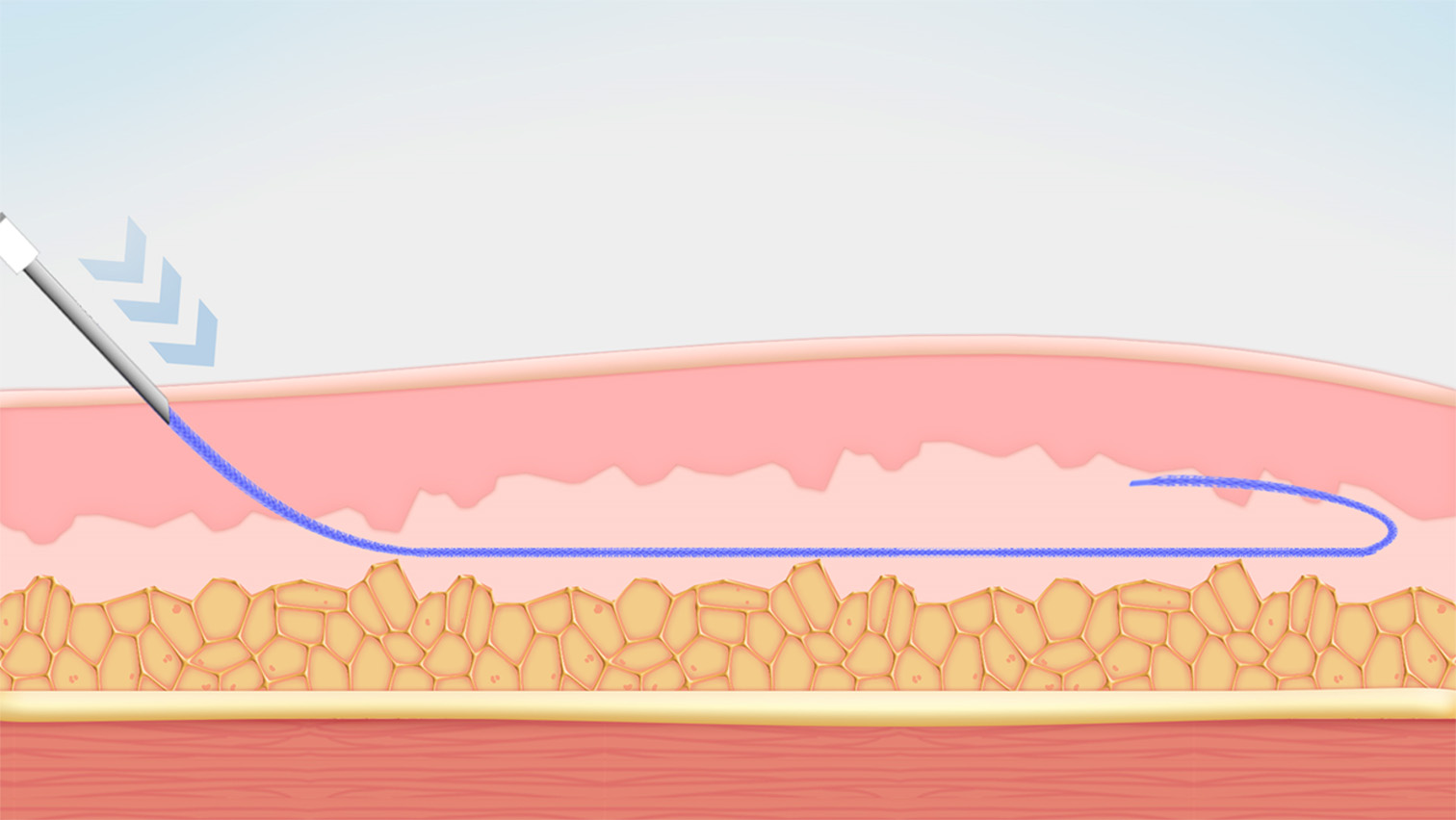 ③残りの糸を挿入します。