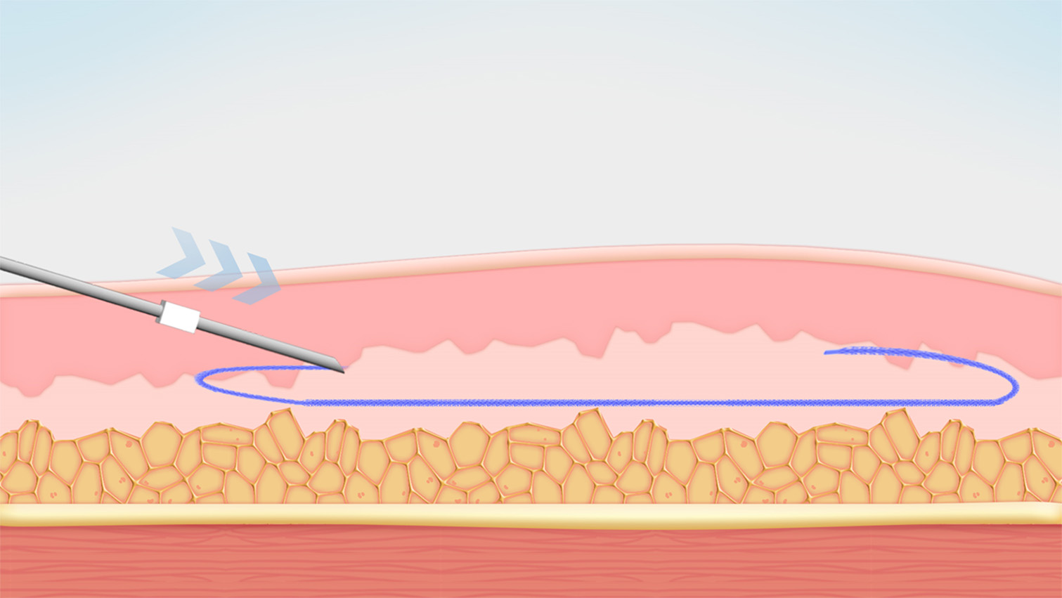 ④糸の最後の部分も折り返し挿入し、強力にホールドします。