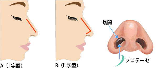 A(I字型)、B(L字型)