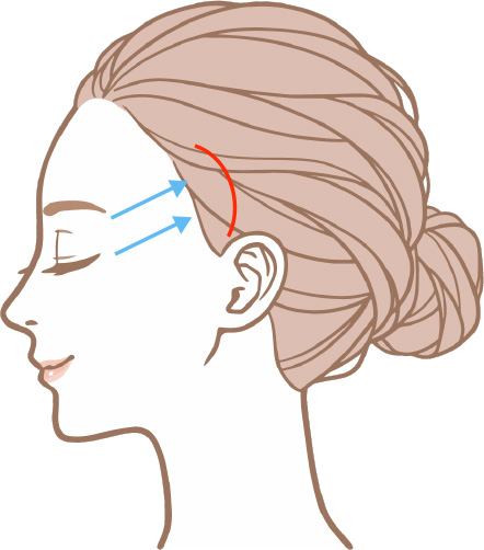 こめかみリフト