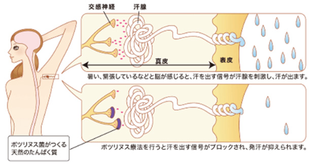 ボツリヌストキシン注射が汗を抑える仕組み